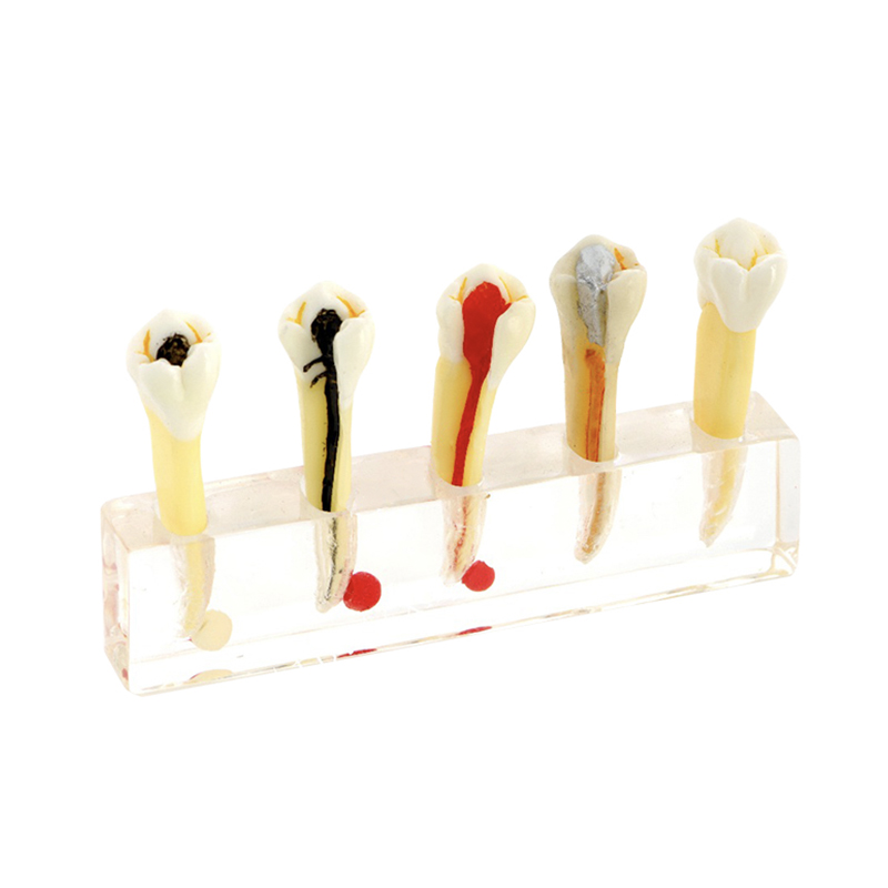 UM-4007 5 Stages for Endodontic Treatment
   