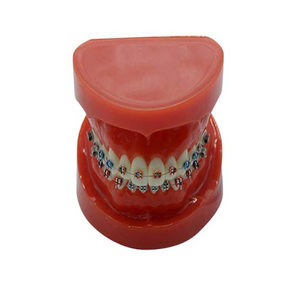Modello di studio UM-B16 con parentesi graffe fisse sui denti (normale)
