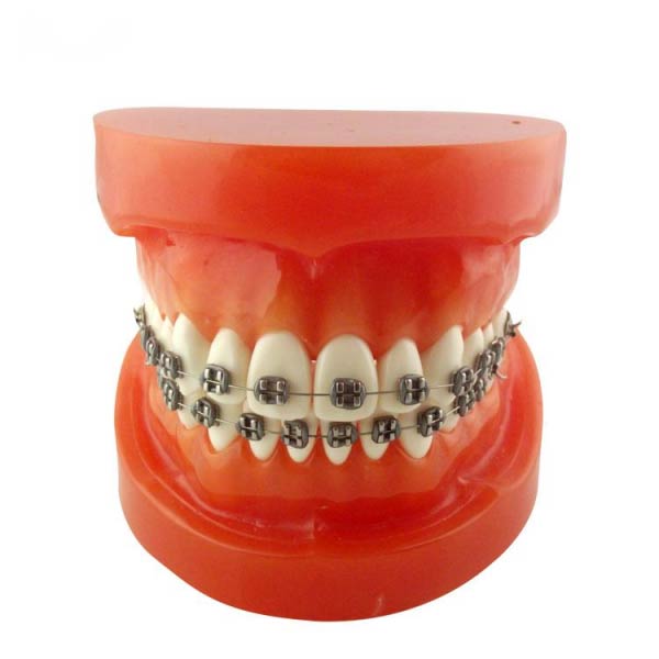 Modello ortodontico UM-B9 (staffe di metallo)