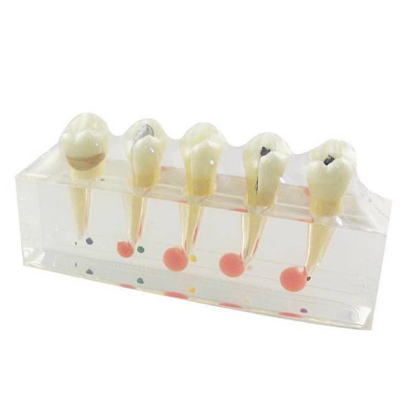 UM-L3A modello clinico della malattia del dente e della polpa dentale